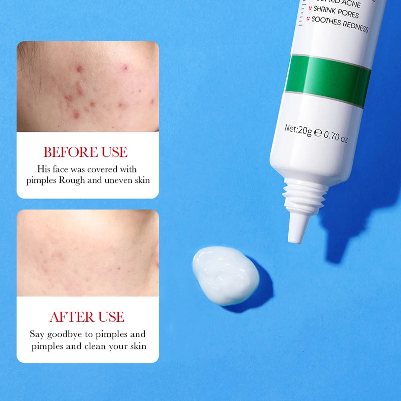 BIOAOUA Salicylic Acid Acne Cream Shrink Pore Cream Elimination Large Pores Remove Blackehead Repairing Skin Care Facial Cream
