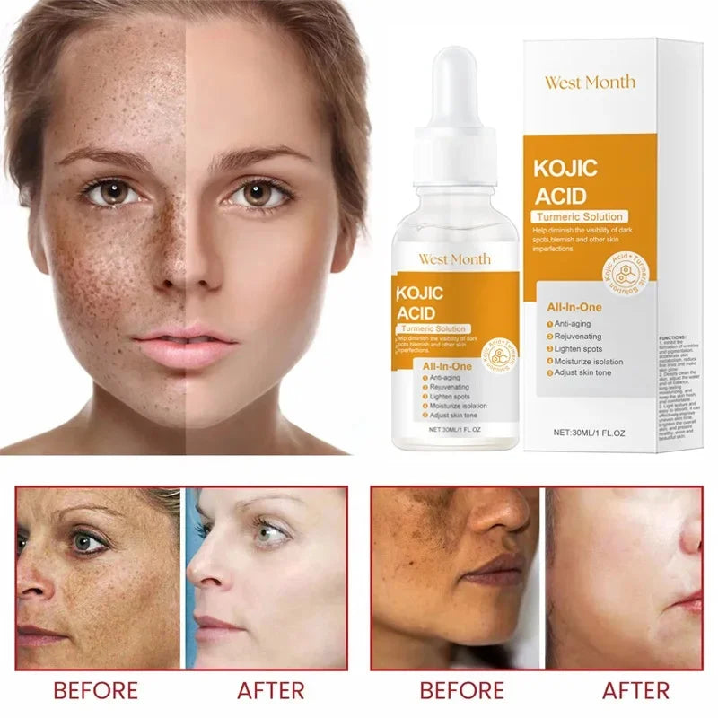 Kojic Acid Freckle Removing Whitening Essence Fade Pigmentation Melasma Dark Spots Corrector Repair Serum Korean Face Skin Care
