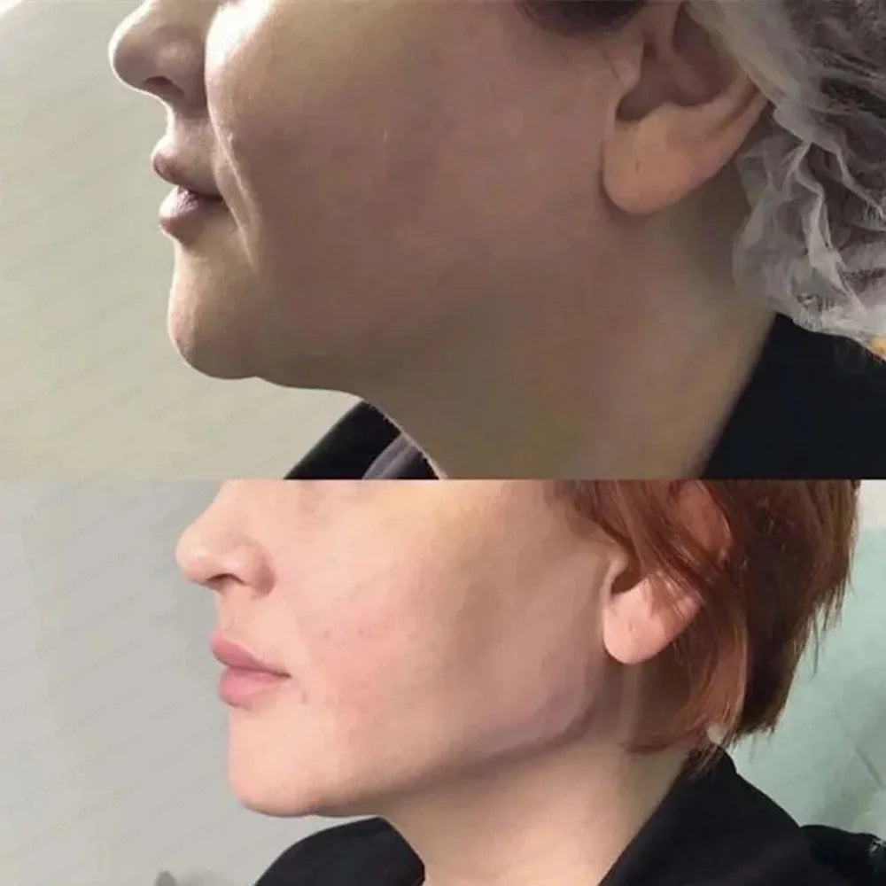 Korean Five Point Facial Lifting Firming Serum Lifting Collagen Hyaluronic Acid Serum Firming Skin 2ml