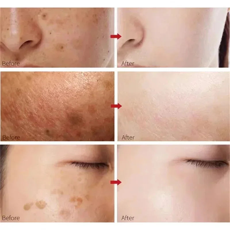 Kojic Acid Freckle Removing Whitening Essence Fade Pigmentation Melasma Dark Spots Corrector Repair Serum Korean Face Skin Care