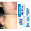 Salicylic Acid Acne Removal Cream Anti-Acne Repair Redness Pimple Spots Deep Cleaning Pore Oil Control Moisturizing Skin Care