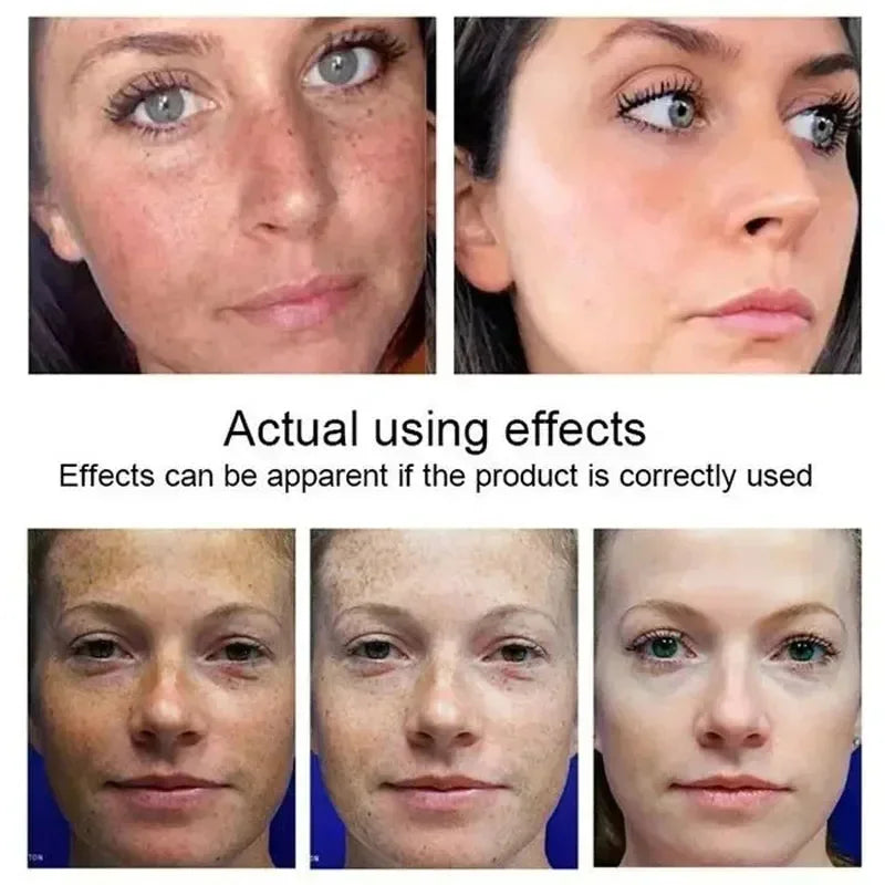 Kojic Acid Freckle Removing Whitening Essence Fade Pigmentation Melasma Dark Spots Corrector Repair Serum Korean Face Skin Care